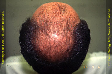 Androgenetic Alopecia (Stage VI)