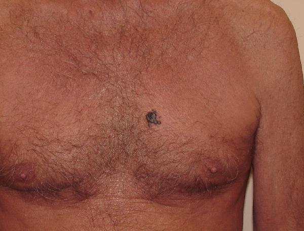 Melanoma Image 11A - Medium