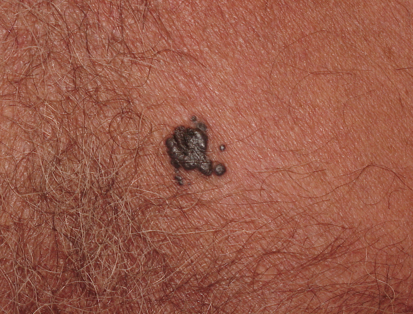 Melanoma Image 11B - Large