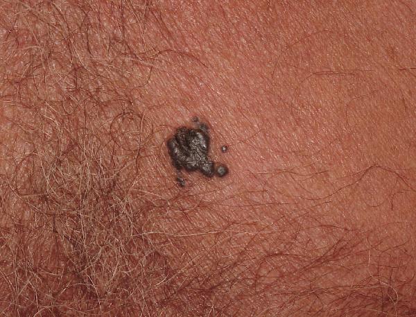 Melanoma Image 11B - Medium