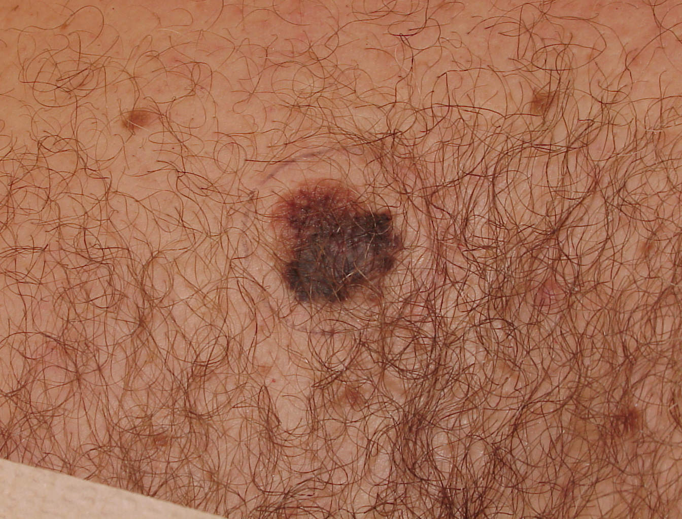 Melanoma Image 13 - Large