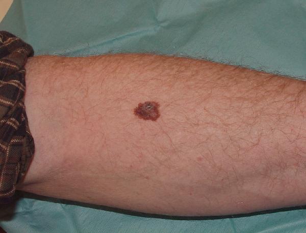 Melanoma Image 16A - Medium