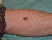 Melanoma Image 16A - Small