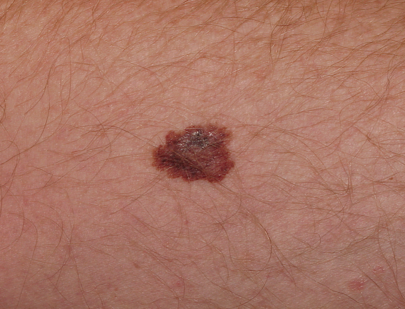 Melanoma Image 16B - Large