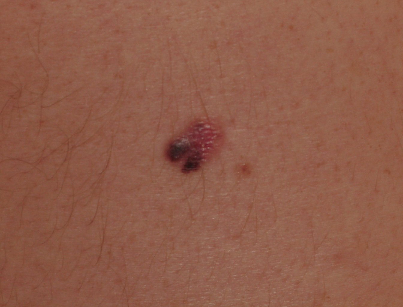 Melanoma Image 18 - Large