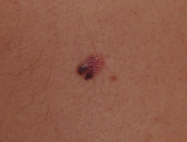 Melanoma Image 18 - Medium