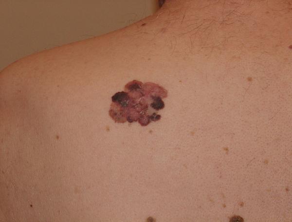 Melanoma Image 19A - Medium