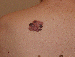 Melanoma Image 19A - Small