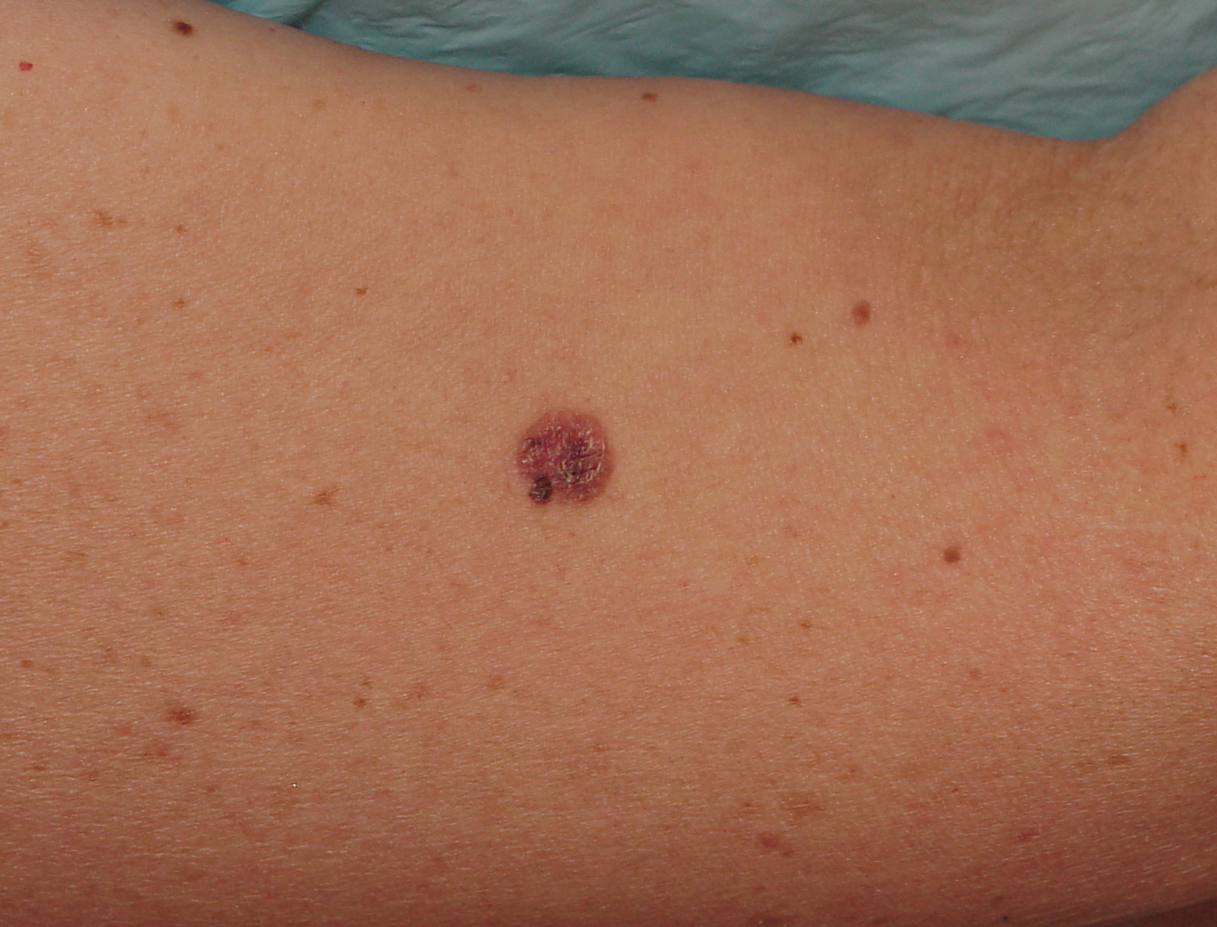 Melanoma Image 1B - Large