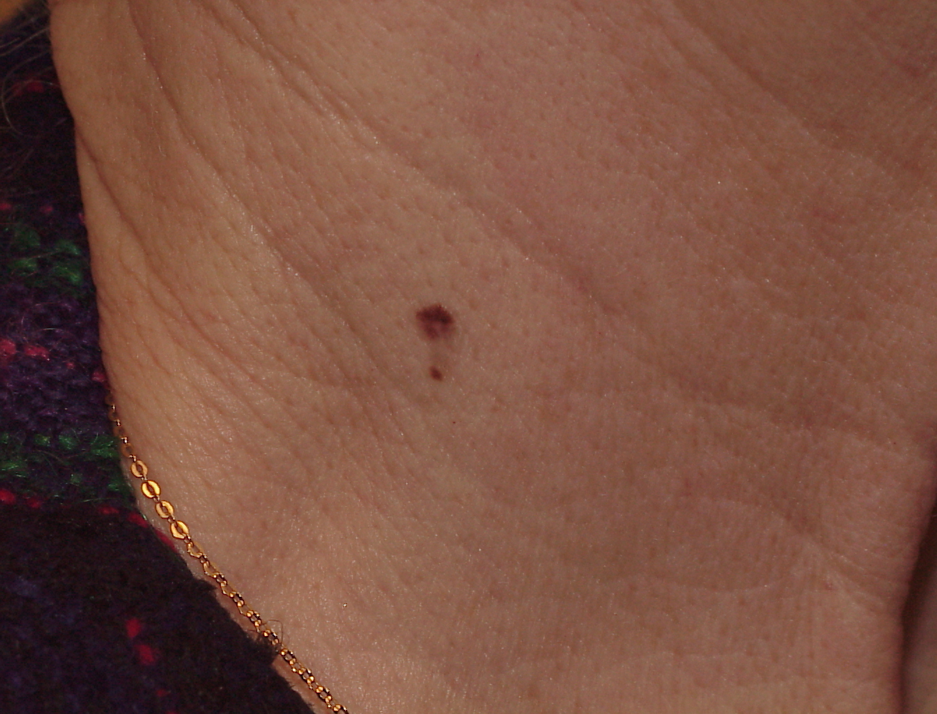 Melanoma Image 5 - Large