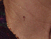 Melanoma Image 5 - Small