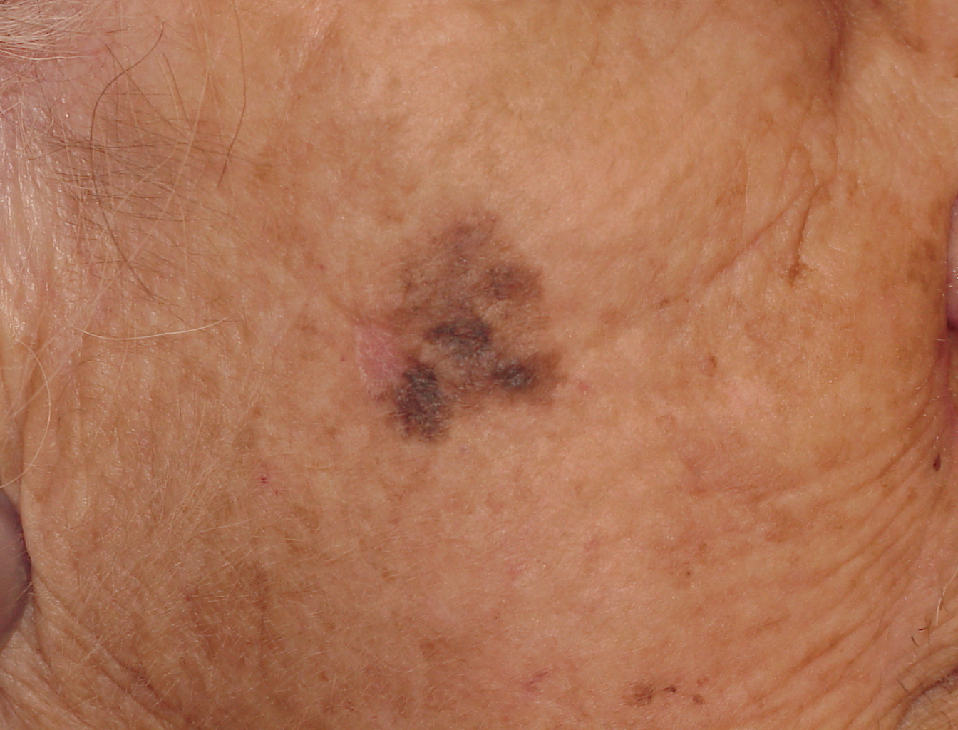 Melanoma Image 6B - Large