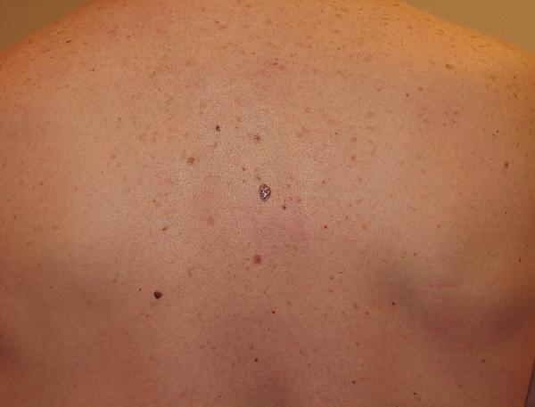 Melanoma Image 9A - Medium