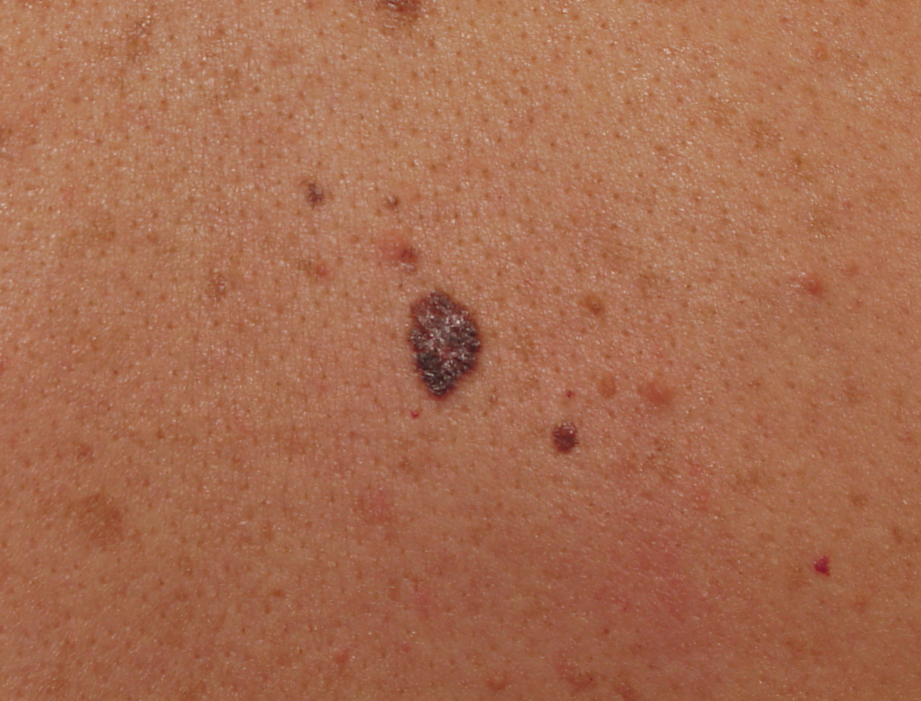 Melanoma Image 9B - Large